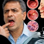 बिना तंबाकू खाए भी हो जाता है मुंह का कैंसर, कारण और बचाव के तरीके जान लीजिए