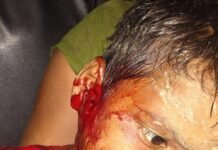 कतर्निया घाट में तेंदुए ने मासूम पर किया हमला:सिर में 12 टांके लगे, पेट में चोट; बुआ के घर आया था