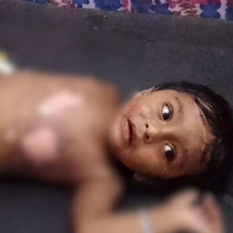 मामूली विवाद में मासूम पर फेंका गर्म दूध, बच्चा झुलसा:श्रावस्ती के अहिरन पुरवा लाल बोझी गांव की घटना; सीएचसी इकौना लेकर पहुंचे